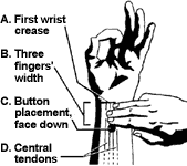 Queaz-Away Travelers' Wristband, Nausea Motion Sickness Relief